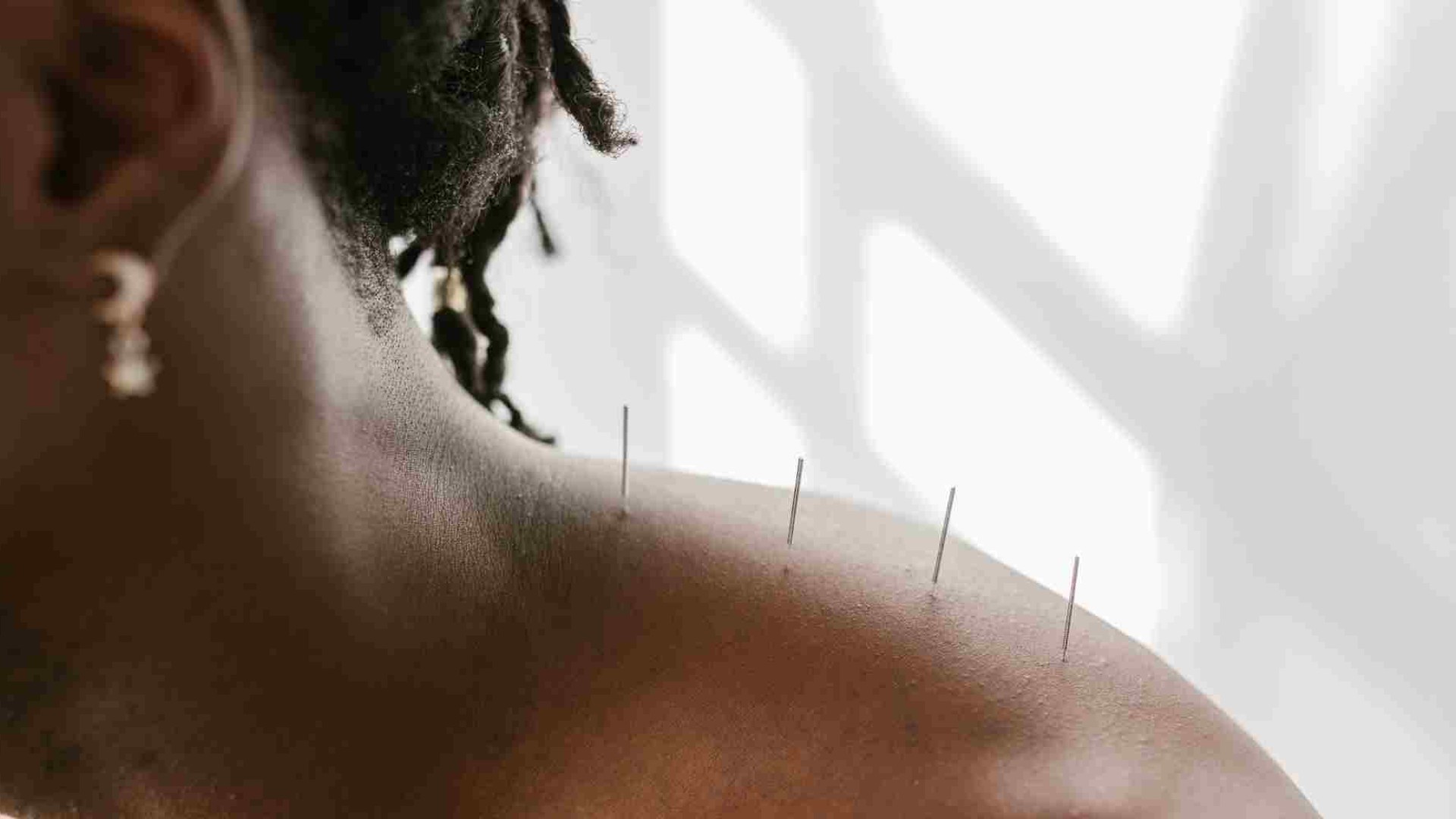 Acupuntura e Cannabis