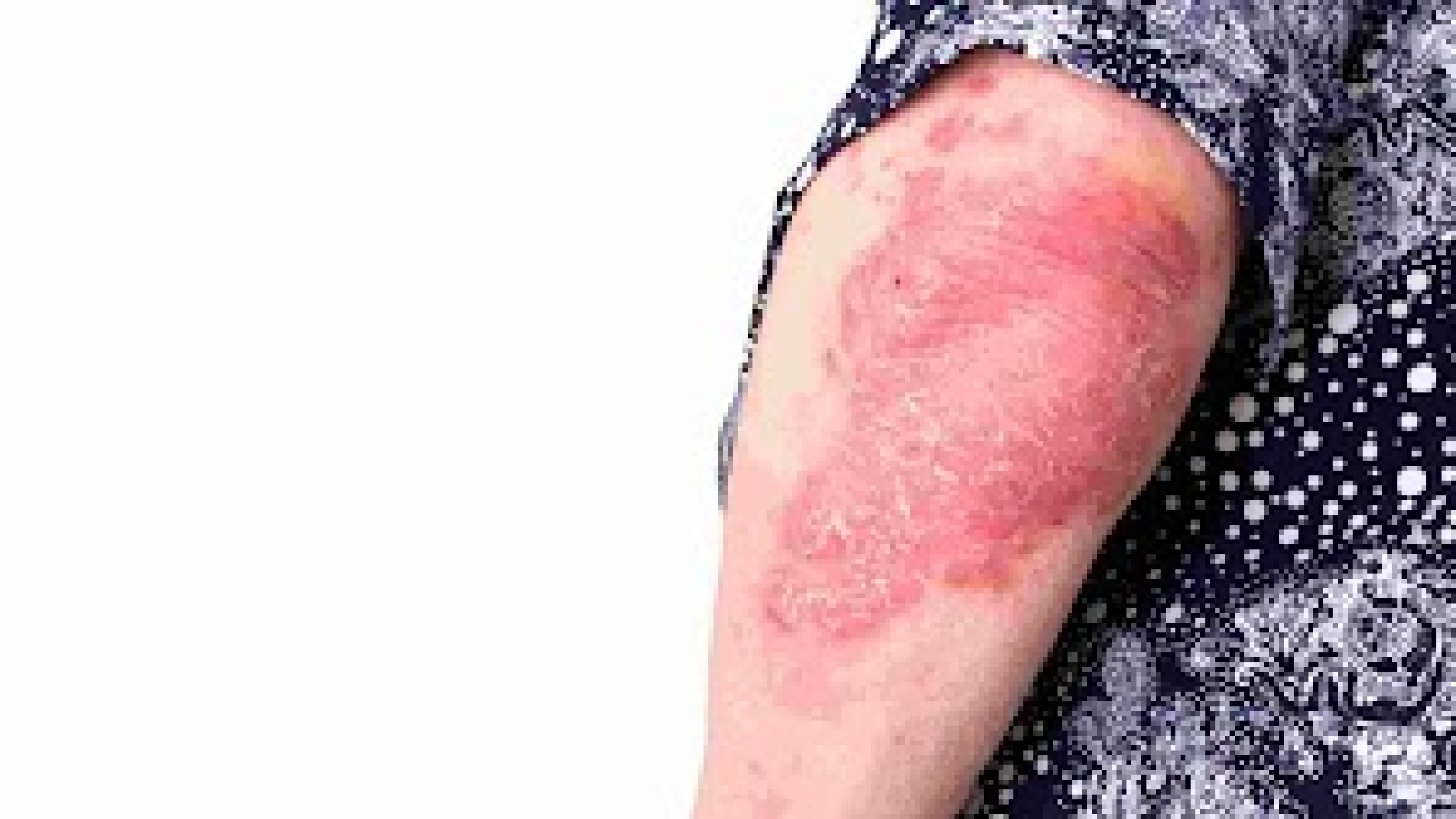 Dia mundial da psoríase